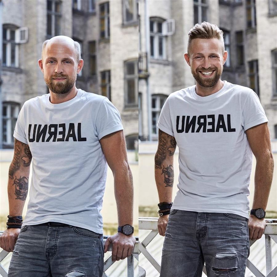 Mandligt Hårtab? Toftild kan hjælpe dig